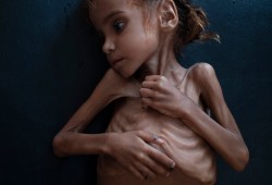 NYT: ما هي قصة الطفلة اليمنية أمل التي أثارت مشاعر العالم؟