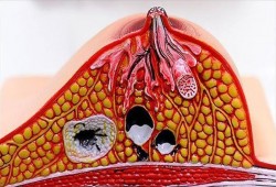 دراسة: عقار لسرطان الثدي قد يضعف وظائف المخ