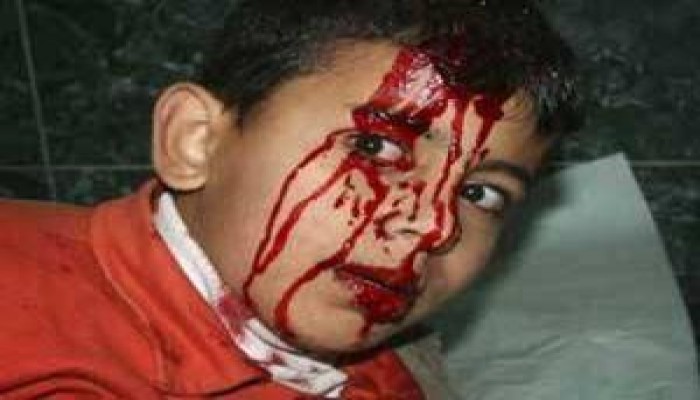 تقرير: 350 ألف طفل فلسطيني في غزة يعانون إصابات جسدية أو نفسية