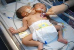 طفل برأسين وقلبين