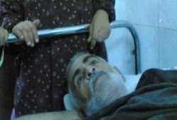 شاش يخرج من بطن مريض بعد 27 عاماً(فيديو)