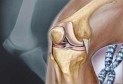 طبيب مصرى يبتكر تقنية جديدة لتسهيل جراحة المفاصل