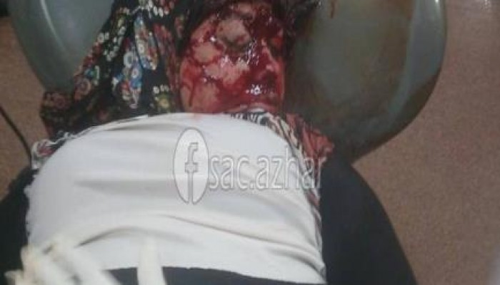 اليوم السابع الانقلابية: تنشر صوراً لطالبة أزهرية مصابة وتزعم انها سقطت برصاص قناصة الطلاب