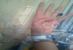 معاناة معتقل من إصابته بالغرغرينة نتيجة التعذيب