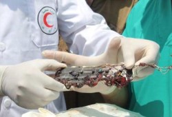 بالصور : اطباء بغزة يستخرجون جزء من لوحة الكترونية لصاروخ صهيوني من جسد طفلة شهيدة