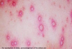 ارتفاع أعداد المصابين بالجدري في سوهاج إلى 44 طفل