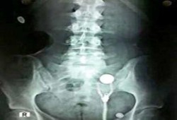 قوات أمن الانقلاب تصيب طالبة بجامعة المنصورة بالرصاص الحى والخرطوش