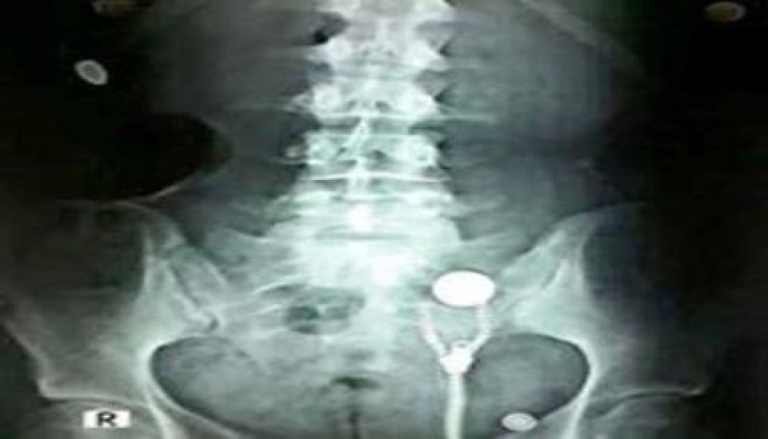 قوات أمن الانقلاب تصيب طالبة بجامعة المنصورة بالرصاص الحى والخرطوش