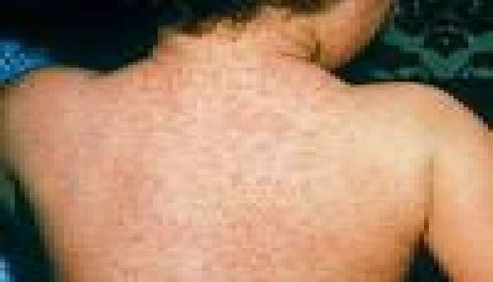 إهمال الانقلاب يؤدي لتزايد معدلات الإصابة بـ"الحصبة" و"الجديرى"