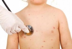 ارتفاع الاصابات بالجديري المائي بين تلاميذ دمياط لـ"72"