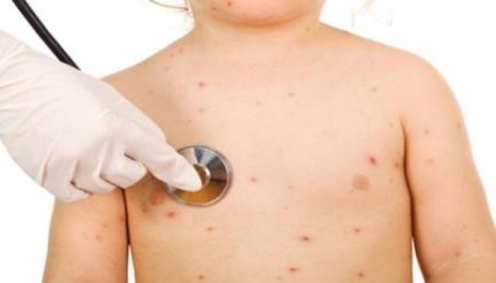 ارتفاع الاصابات بالجديري المائي بين تلاميذ دمياط لـ"72"