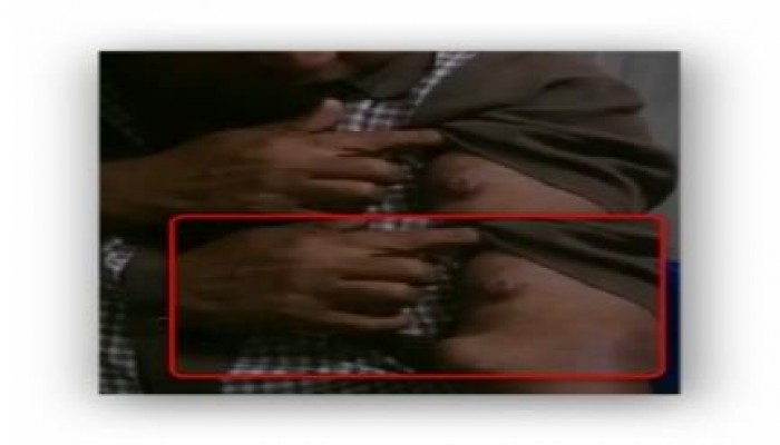 بالفيديو.. مآسي مرضى الفشل الكلوي في ظل تجاهل حكومة الانقلاب