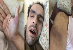 صور مأساوية توضح حالة محمد سلطان بعد 360 يوم من الإضراب عن الطعام داخل معتقل العسكر