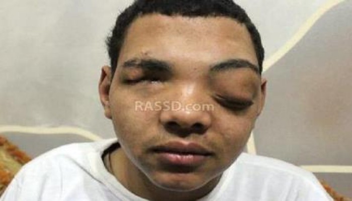 الطفل "محمد بليغ" فقد عينيه في مذبحة رابعة: "عنيه سبقتني لربنا.. ونفسي أشوف يوم النصر"