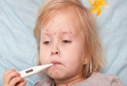 إصابة 35 طفل بـ"الجديري المائي" فى "إهناسيا" ببني سويف