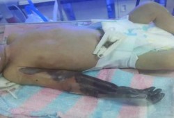 بسبب الاهمال..مأساة بتر ذراع طفل رضيع عمره 15 يوماً داخل إحدى حضَّانات كفر الشيخ(صور)