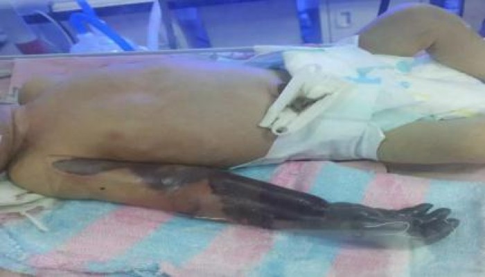 بسبب الاهمال..مأساة بتر ذراع طفل رضيع عمره 15 يوماً داخل إحدى حضَّانات كفر الشيخ(صور)