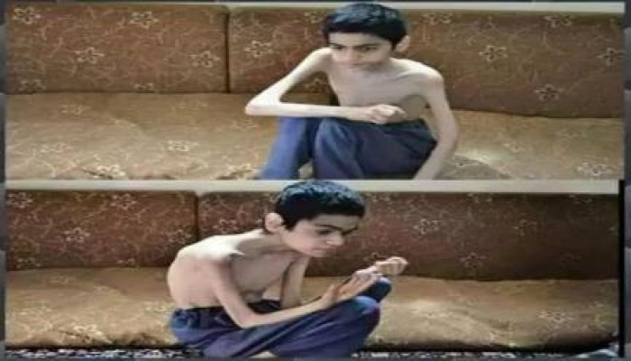 بالصور..شاهد الهياكل العظمية داخل بلدة "مضايا" السورية بسبب حصار المجرم بشار وحزب الله لهم