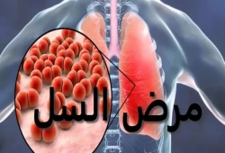 علاج جديد يطلق "بداية نهاية مرض السلّ المقاوم للأدوية"