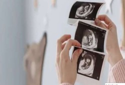 وفاة امرأة حملت جنيناً متحجّراً 9 أعوام