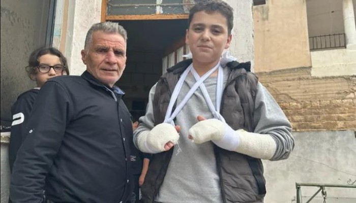 الصور الفاصلة .. فارق المعاملة بين القسام وتشوهات التعذيب بسجون الاحتلال