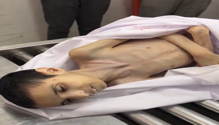 عدد شهداء سوء التغذية يرتفع إلى 23.. الجوع يقتل 3 أطفال في غزة