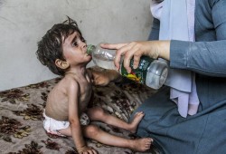 الأمم المتحدة: أكثر من 50 ألف طفل فلسطيني يحتاجون إلى علاج من سوء التغذية الحاد