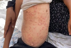 أكثر من مليون و700 ألف حالة مرضية بسبب انتشار الأوبئة في غزة