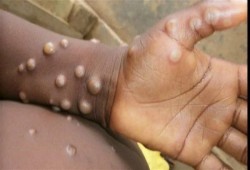 الصحة العالمية تعلن جدري القرود حالة طوارئ صحية عالمية