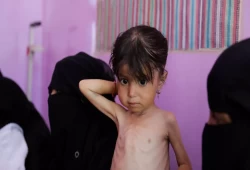 سوء التغذية الحاد ينتشر في المناطق الخاضعة لسيطرة الحكومة في اليمن