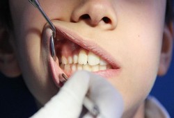 اكتشاف علاج طبيعي لالتهابات وأمراض اللثة