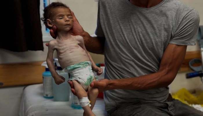 "الجوع في غزة".. مليون طفل على حافة الموت والمجتمع الدولي يتفرج (فيديو)