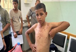 الأوبئة تحاصر النازحين في غزة.. موت خلف خيام ممزقة