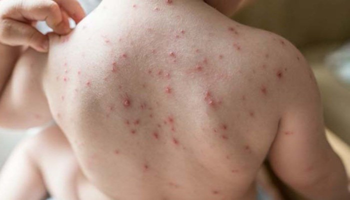 عزل 10 طلاب في المنوفية بعد إصابتهم بالجدري المائي