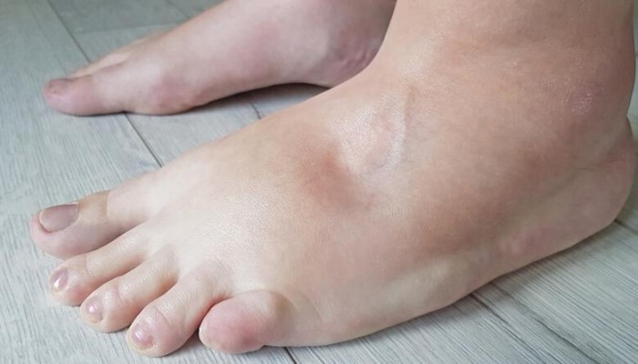 متى يكون تورم القدم مؤشرًا على الإصابة بأمراض مميتة؟