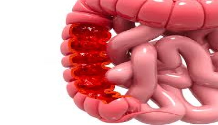 6 أعراض لسرطان القولون لا يجب تجاهلها أبدًا