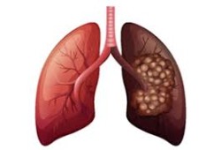 العلماء يبتكرون أول لقاح لسرطان الرئة في العالم 