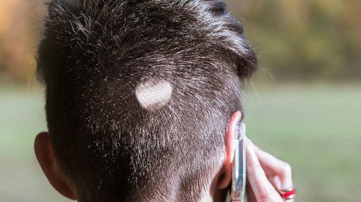 احذر: هذه الأشياء تؤدي إلى الصلع وتنشر فطريات شديدة العدوى