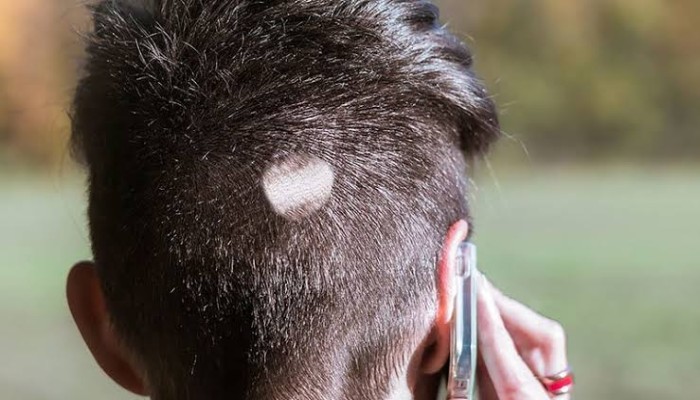 احذر: هذه الأشياء تؤدي إلى الصلع وتنشر فطريات شديدة العدوى