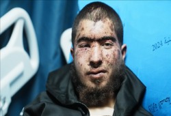 "أويس" يروي من سرير العلاج.. كيف نجا من تعذيب المستوطنين غربي رام الله