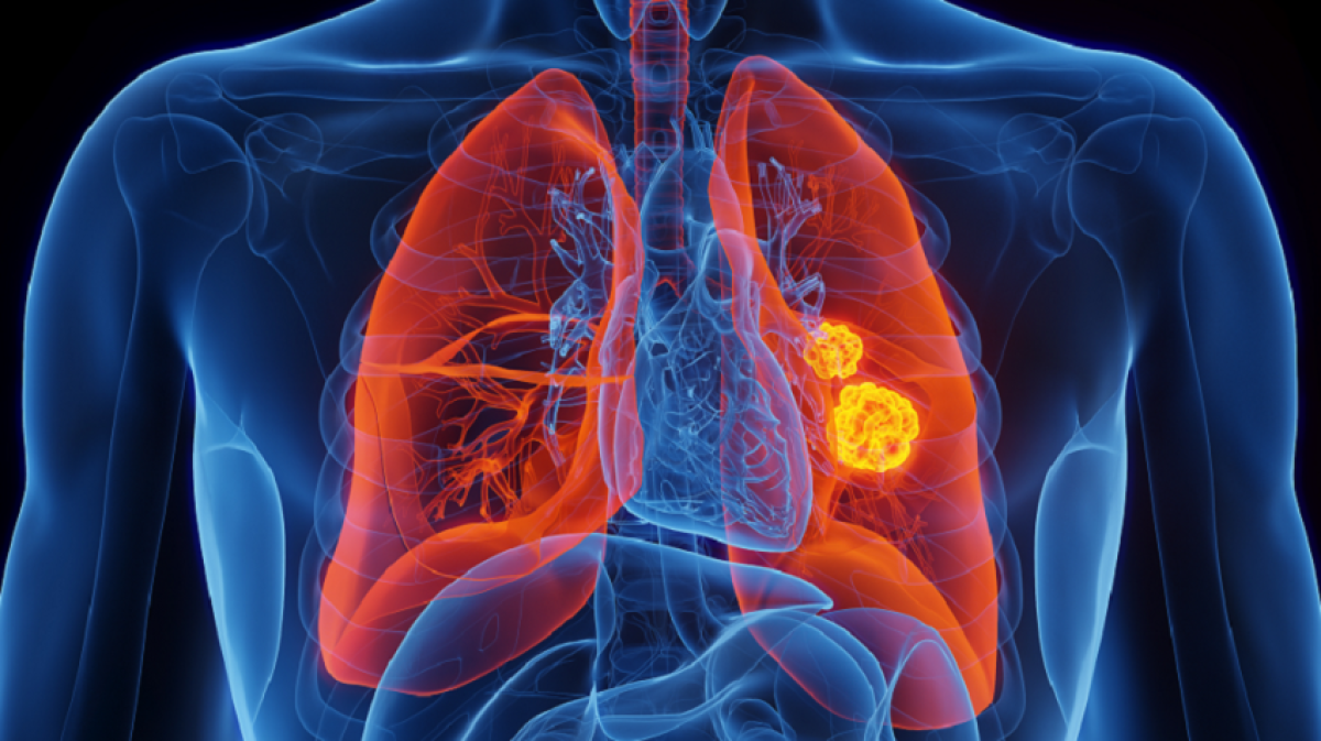 8 أعراض لسرطان الرئة.. هؤلاء الأكثر عرضة للخطر