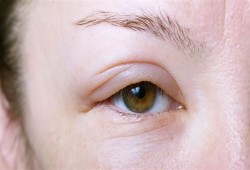 طرق فعالة لمحاربة انتفاخ العينين في فصل الشتاء