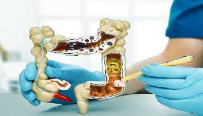 سر ارتفاع الإصابة بسرطان القولون بين الشباب