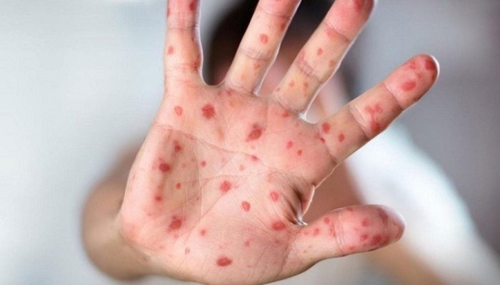 مرض الجدري المميت يُنذر بظهور "جائحة جديدة"