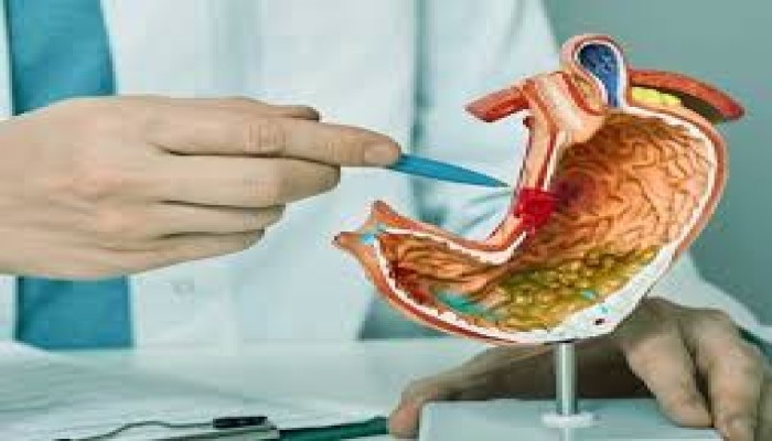 أسباب الإصابة بسرطان الأمعاء وعلامات الخطر