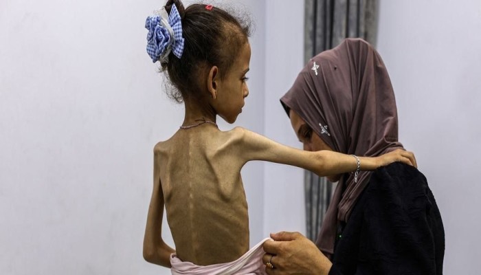 غزة تواجه خطر الانهيار الصحي مع سوء التغذية وتدهور مراكز الإيواء