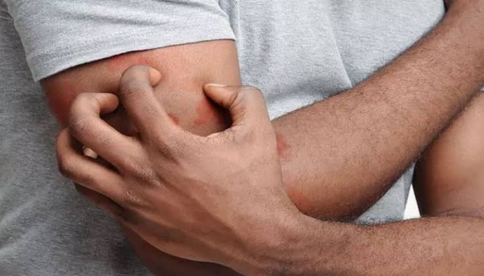 لهذه الأسباب.. احذر الحكة عند تعرضك للدغة حشرة