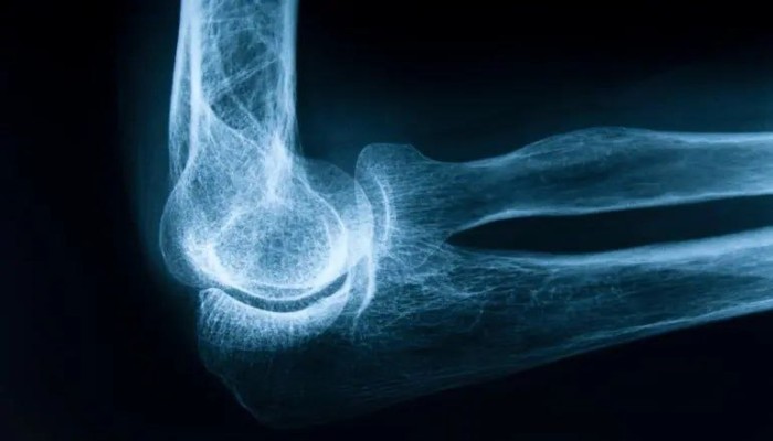 بدون مكملات.. 5 طرق طبيعية لتعزيز قوة العظام والوقاية من الهشاشة