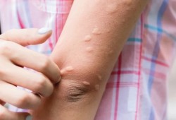 "أرتيكاريا البرد." حساسية خفية قد تهدد الحياة.. تعرف على أعراضها